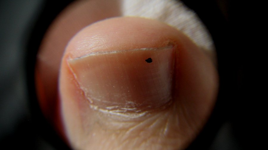 Mesa podiatrist gets FDA approval for laser toenail fungus treatment Phoenix Business Journal