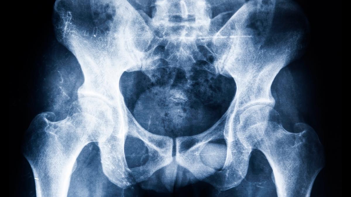 Signs Of A Worn Hip Joint