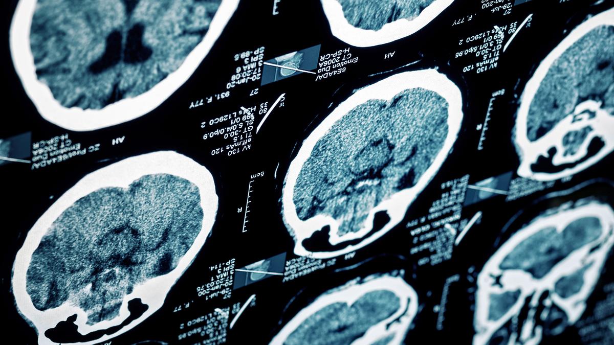 Stroke Rehabilitation Centers Market May See a Big Move | Major Giants ...