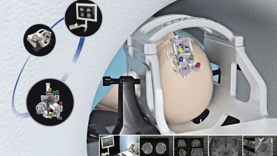 Clearpoint Device MRI Interventions finding more uses for ClearPoint device - Memphis ...