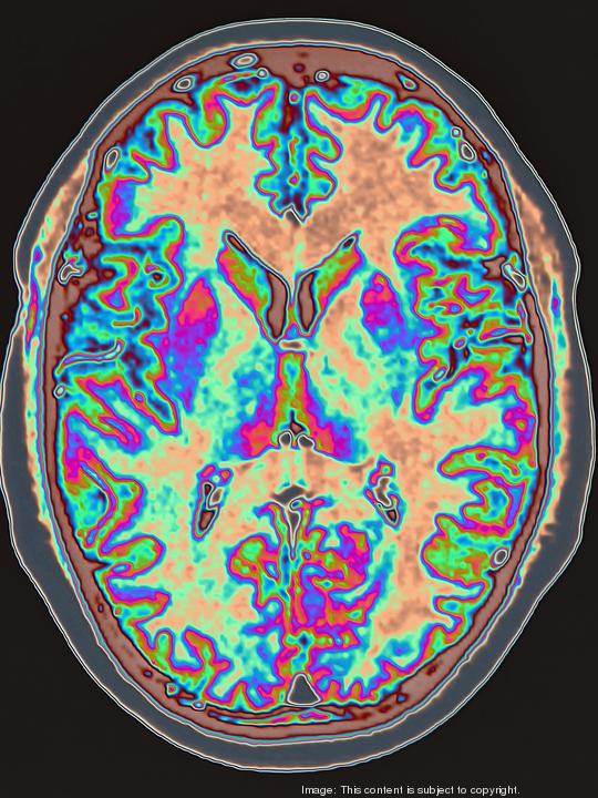 MRI scan of brain