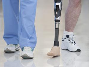 Nurse helping man walk with prosthetic leg