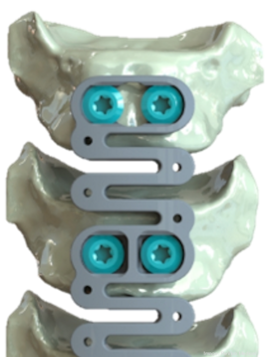 ReVivo Medical 2 level plate