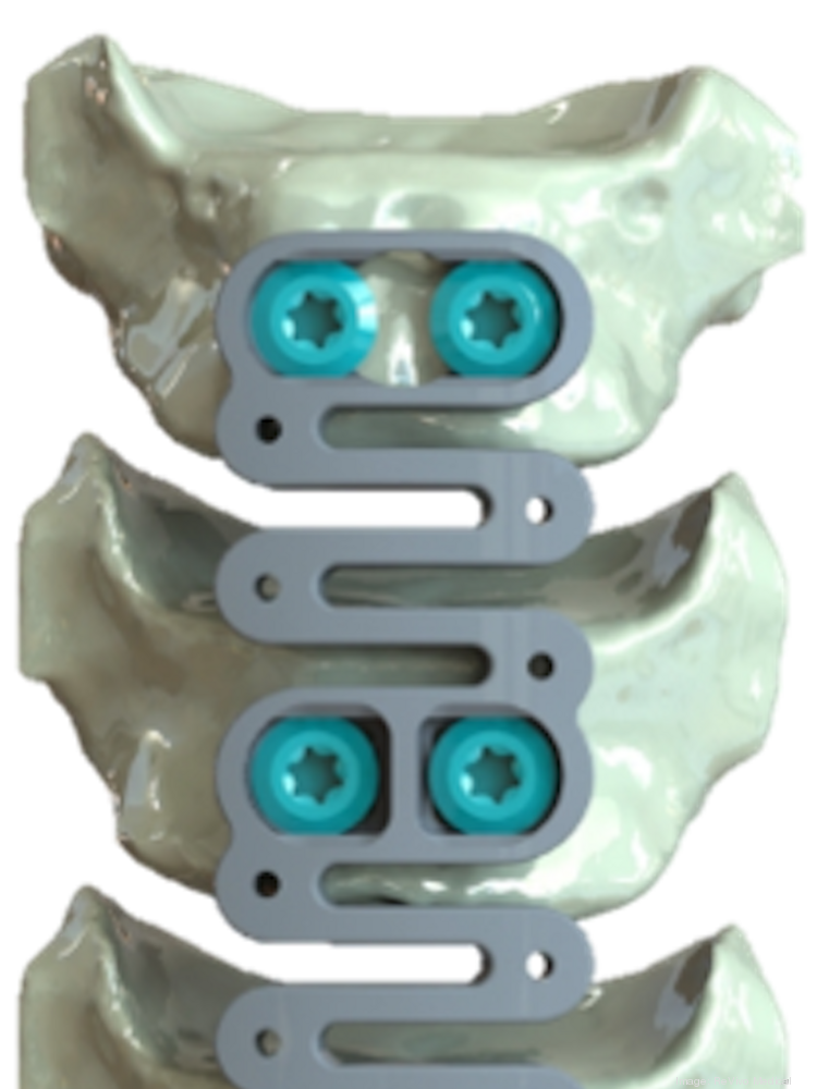 Image result for ReVivo Medical spine