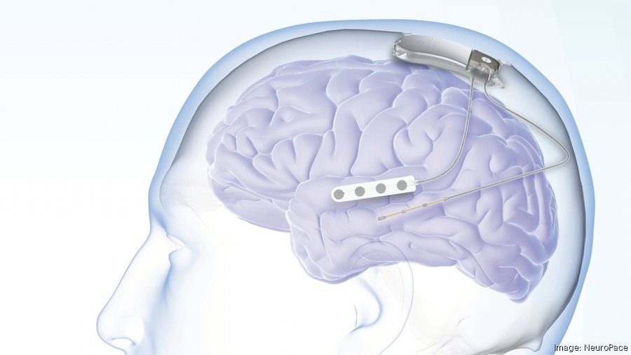 Epilepsy device maker NeuroPace files to go public - Silicon Valley ...