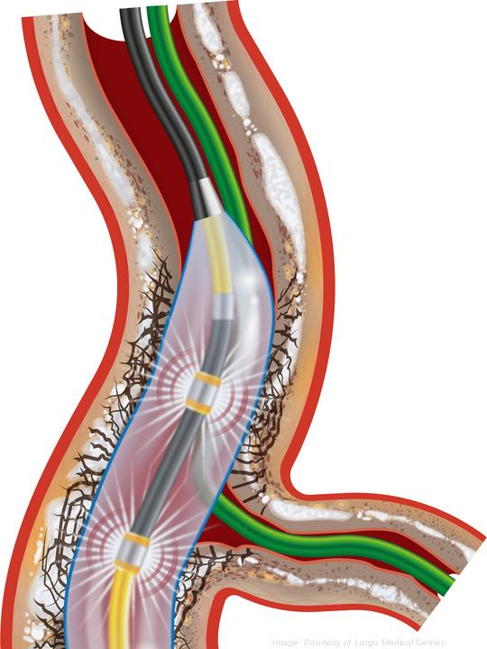 Shockwave Catheter in Artery