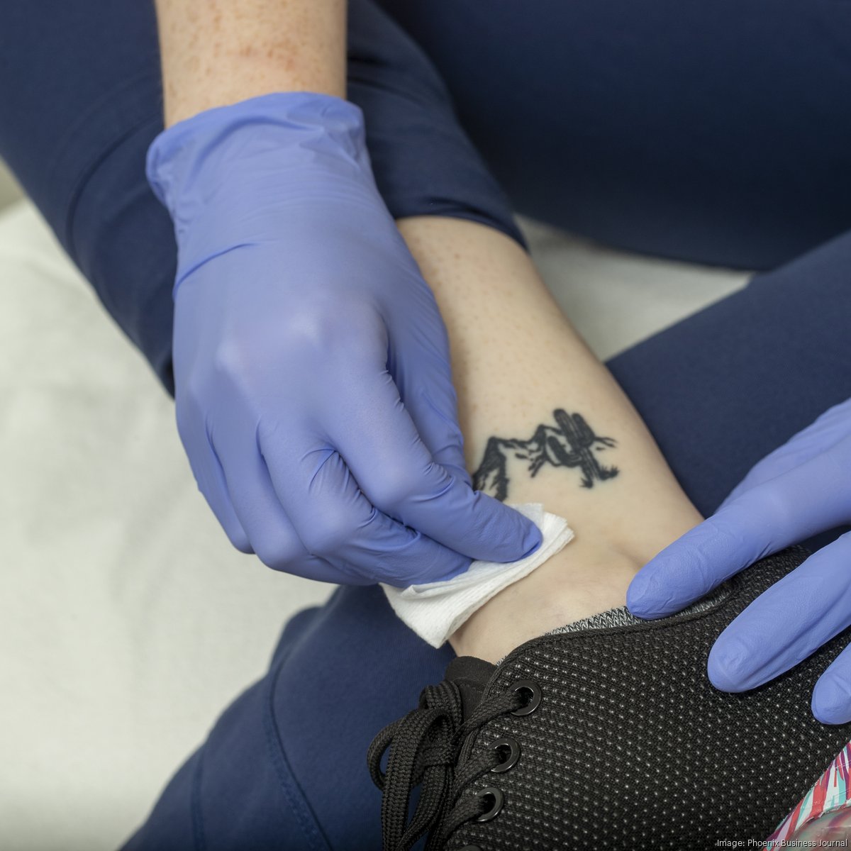 Laser Tattoo Removal Buffalo NY  Laser Tattoo Removal in Williamsville