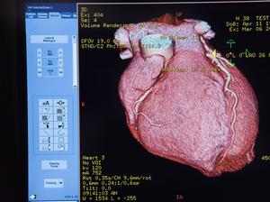 How one health system is using radiation to treat heart patients who’ve run out of options