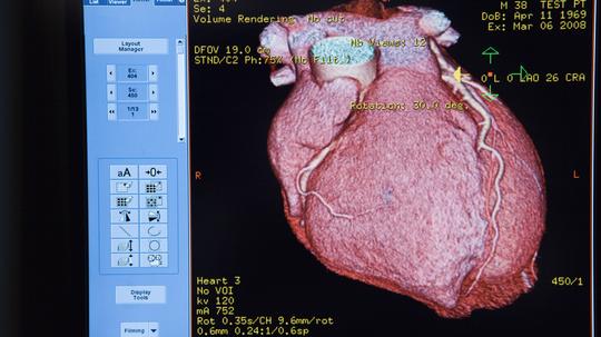 How one health system is using radiation to treat heart patients who’ve run out of options