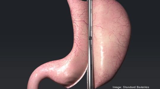 Titan SGS Stomach Illustration