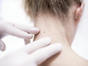 Doctor examining patient's mole