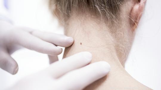 Doctor examining patient's mole