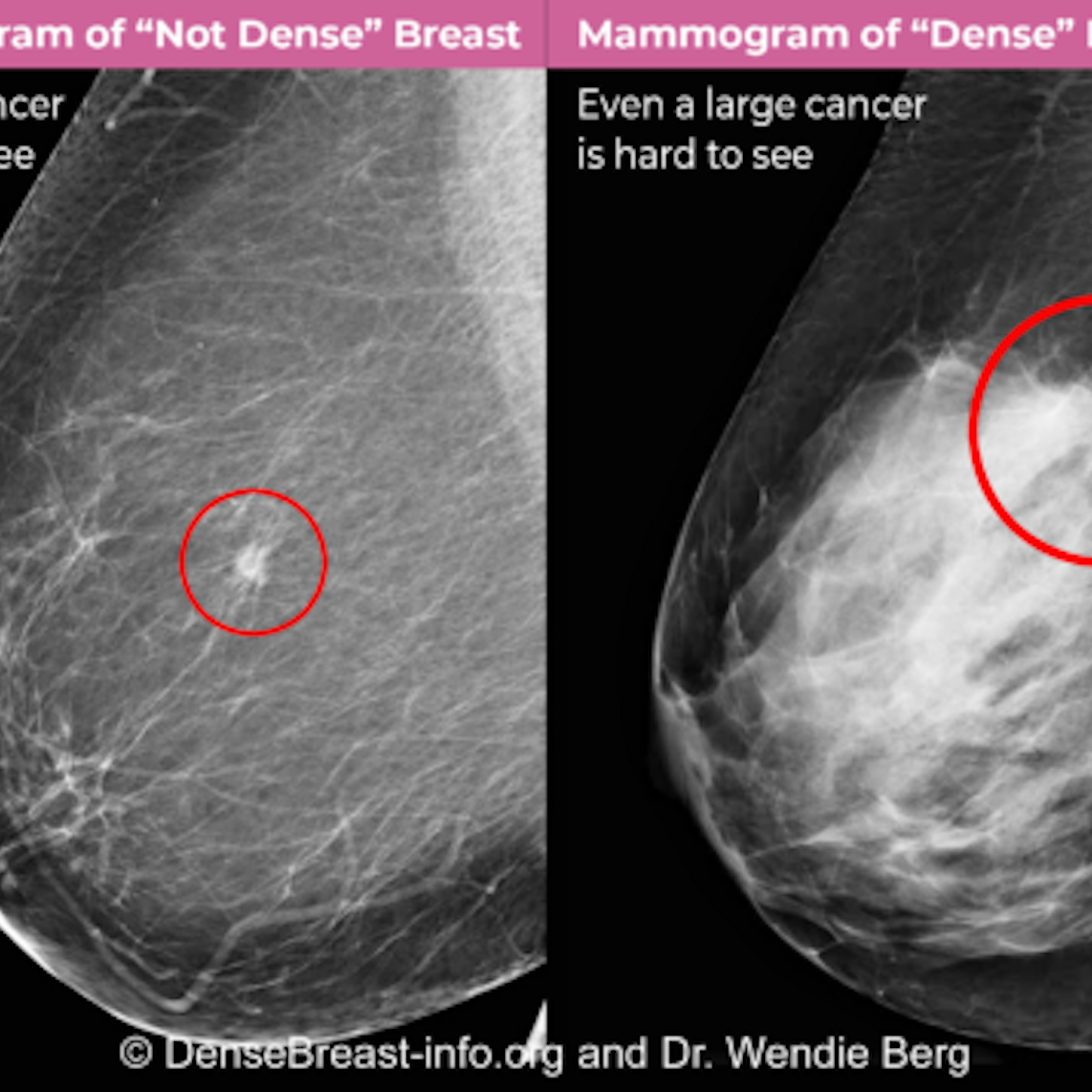 What I Wish I Had Known About Breast Cancer – Dense Breasts Canada