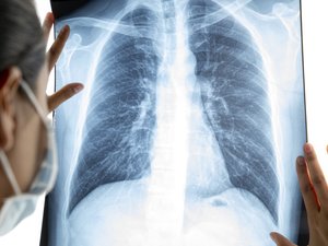 Female doctor analyzing lung x ray film in the lab