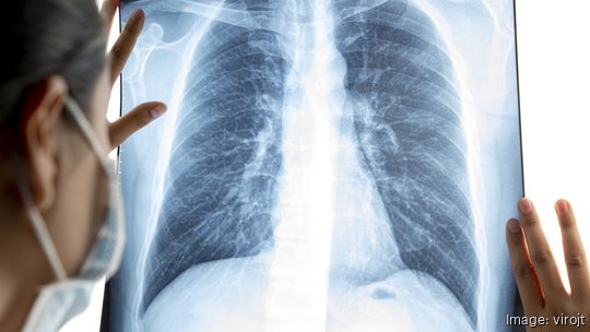 Female doctor analyzing lung x ray film in the lab