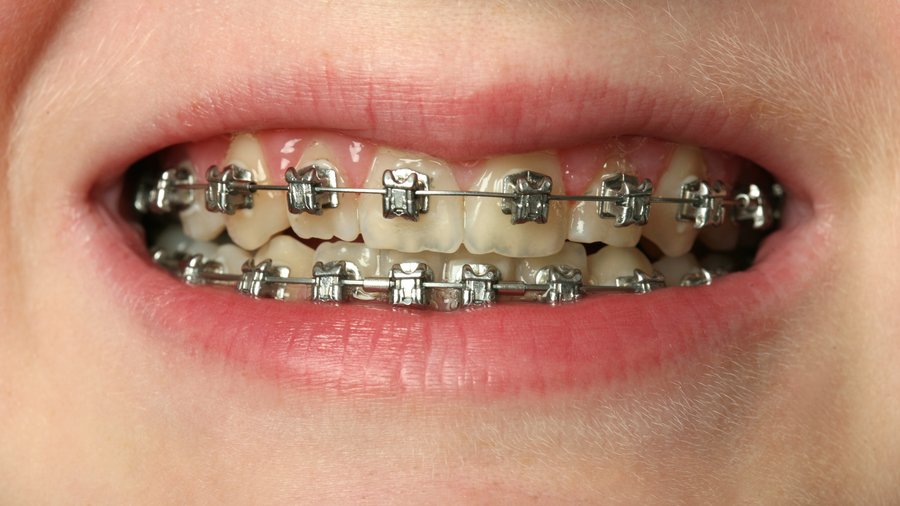 Expanded orthodontic coverage on the table for Oregon Health Plan