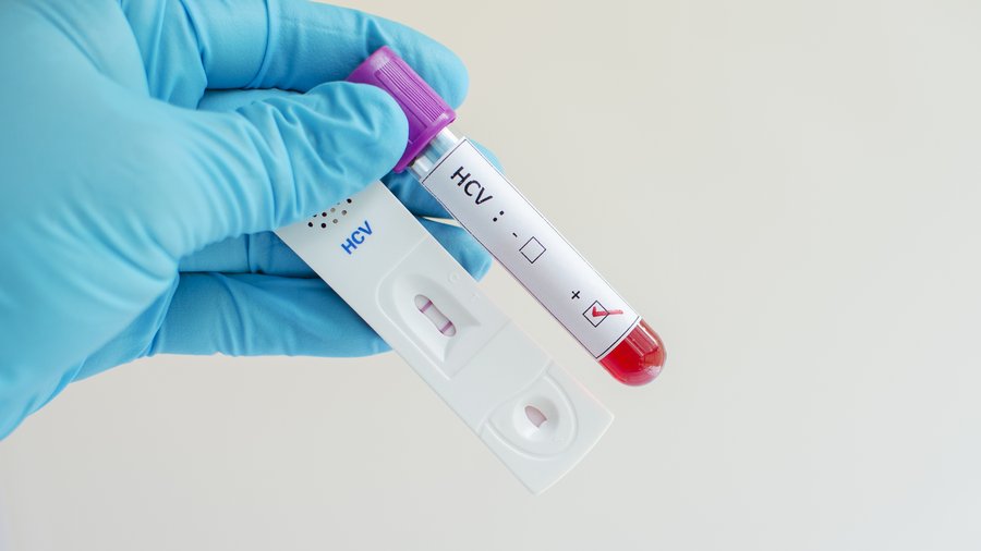 Oregon to expand Medicaid coverage to more hepatitis C patients